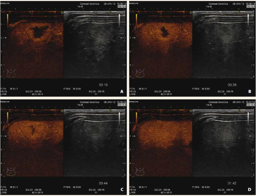 Hemangiom jater CEUS časná arteriální fáze (A), arteriální fáze (B), portální fáze (C), pozdní fáze (D). Typický patognomický
obraz centripetální nodulární opacifikace ložiska.<br>
Fig. 3. Liver haemangioma in early arterial phase (A), arterial phase (B), portal phase (C), late phase (D). Typical patognomical
sign of centripetal nodular opacification of lesion.