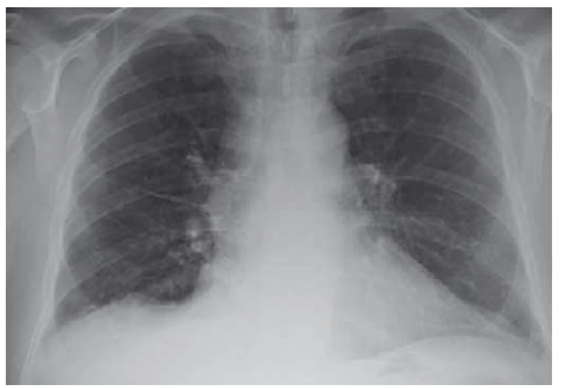 RTG plic po léčbě – nález v regres (10/2018).<br>
Fig. 4. Lung X-ray after treatement – regression (10/2018).