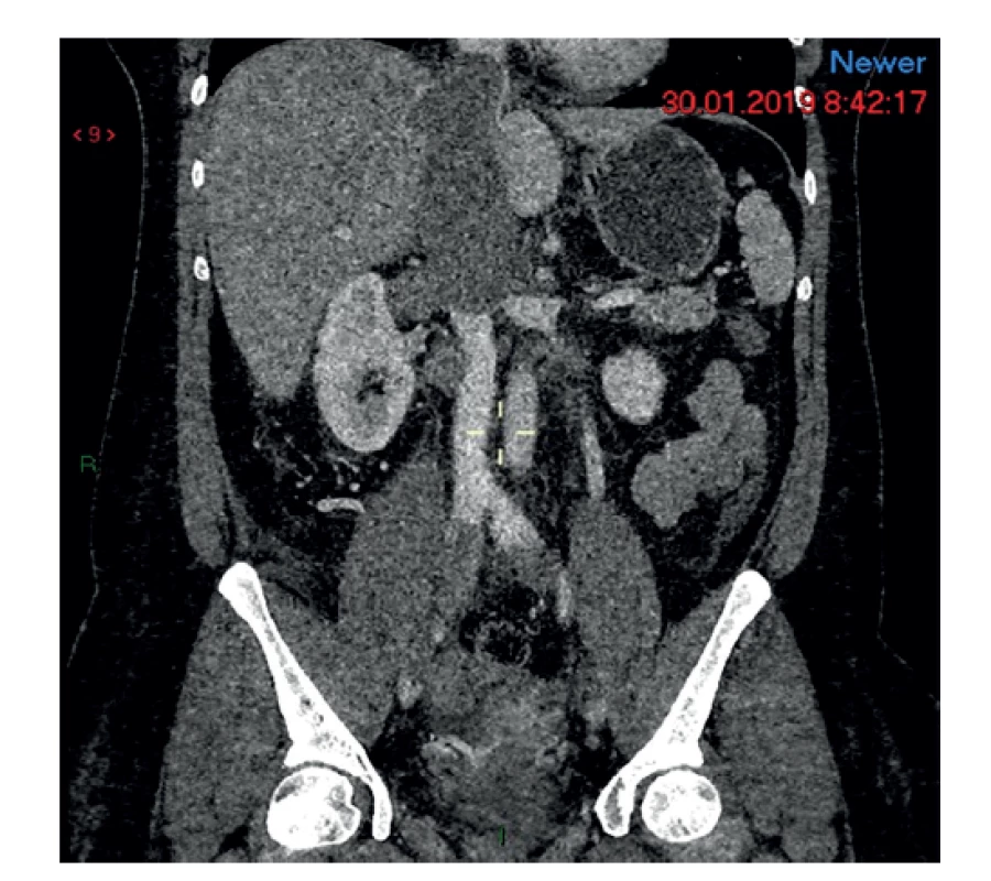 Nádorový trombus vo vena cava inf.<br>
Fig. 3: Tumor thrombus in the inferior vena cava