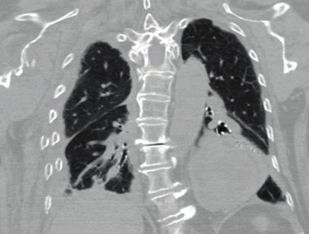  CT 2D coronal reconstruction of serial fracture of the ribs on the
right with a gross chest wall deformity