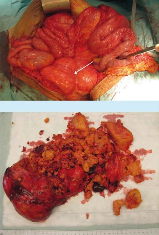 Obsahem ventrální kýly byly střevní kličky,
dutina břišní vyplněna tumorem (označen šipkou)
(a). Odstraněný preparát angiomyolipomu při jedné
z cytoredukčních operací (b).<br>
Fig. 2. Small intestine was packed in ventral hernia as abdominal cavity was completely filled with
kidney tumour (arrow) (a). Angiomyolipoma mass
removed during one of cytoreductive surgeries (b)
