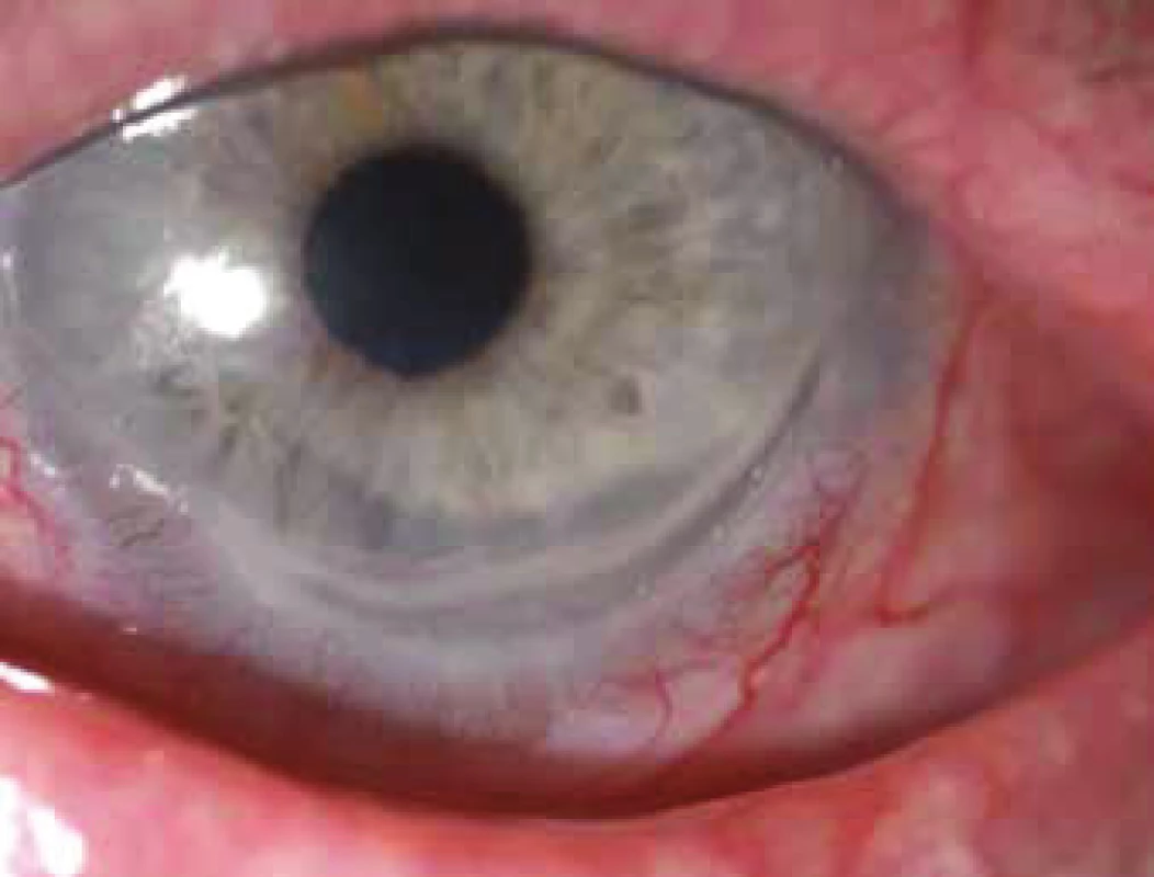 Peripheral ulcerous keratitis – pronounced constriction of
cornea, infiltrated cornea