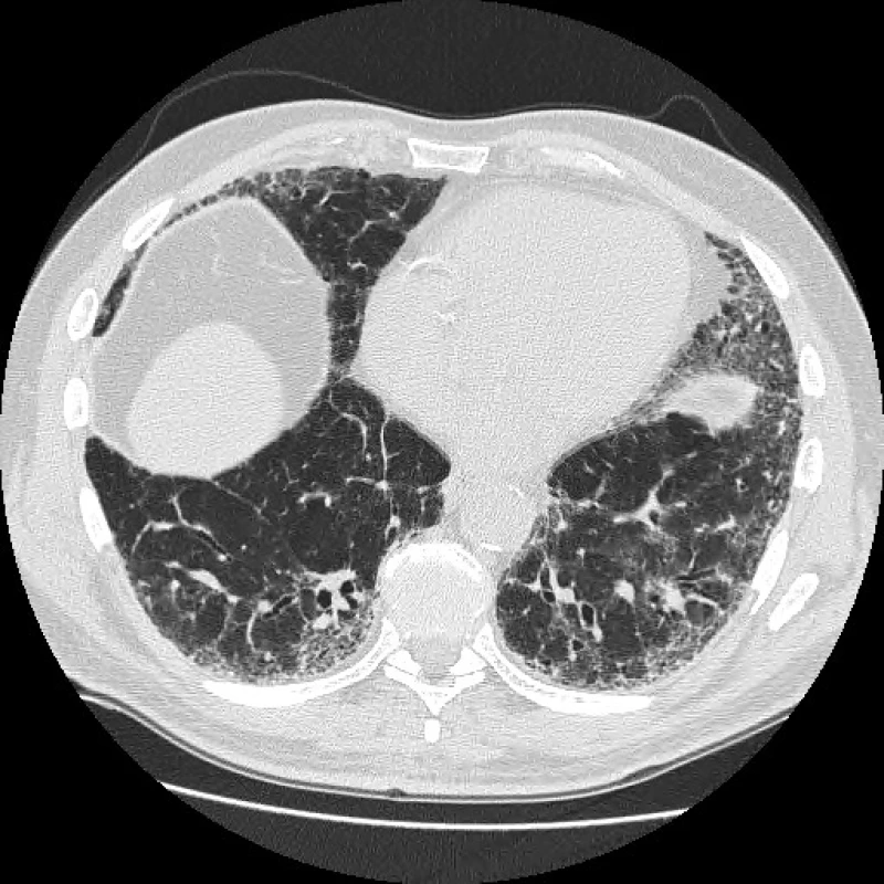 Radiologický obraz pravděpodobné UIP, bez voštinovité
plíce s trakčními bronchiektasiemi