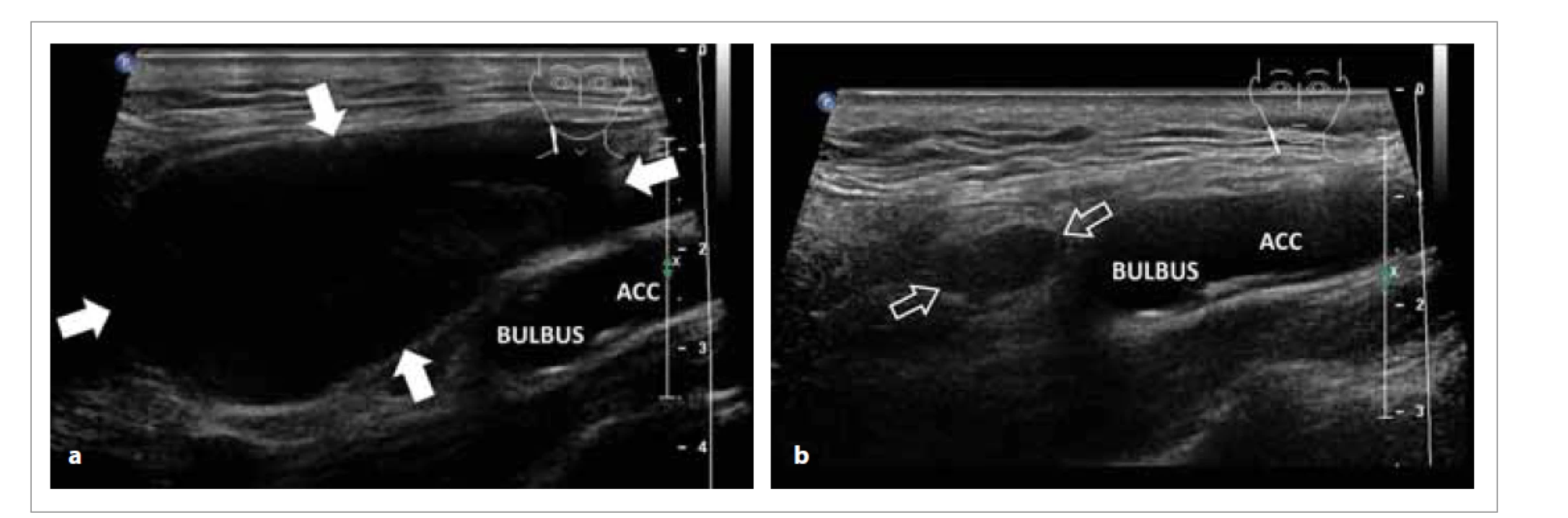a) Muž 72 let, před US-PEIT: krční cysta – ranula lokalizovaná pod úhlem mandibuly, zasahuje až k bulbu ACC,
objem 35 ml (plné šipky).<br>
Obr. 1b) Jeden rok po 2x US-PEIT: malé solidní reziduum, objem 0,4 ml (prázdné šipky); podélně.<br>
ACC – arteria carotis communis, VJI – vena jugularis interna<br>
Fig. 1a) Man 72 years old, before US-PEIT: cervical cyst – ranula located at an angle of the mandible, extends to the bulb ACC,
volume 35 ml (solid arrows).<br>
Fig. 1b) One year after 2x US-PEIT: small solid residue, volume 0.4 ml (empty arrows); lengthwise.