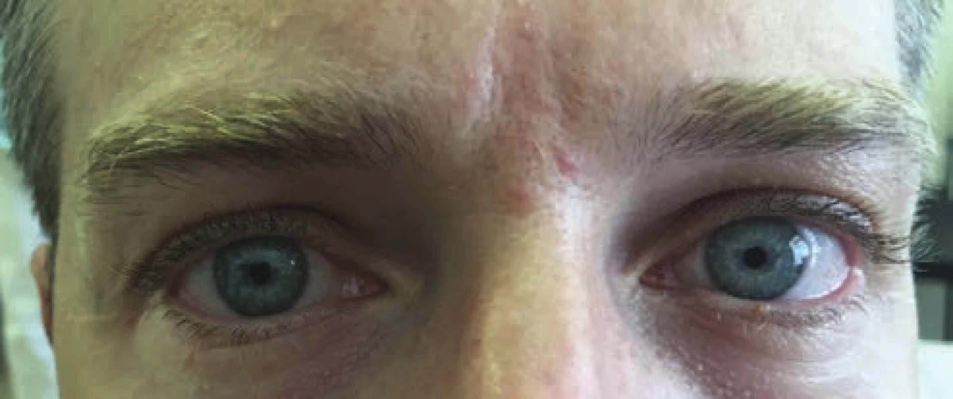 Pacient po podaní coll. pilocarpini 0,125 % gtt a následné zúženie zrenice na pravom oku 