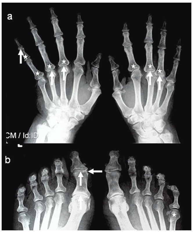 RTG snímek rukou (a) a nohou (b) ve AP projekci:
periartikulární poróza (*), zúžení kloubní štěrbiny (↑) a eroze (←).
