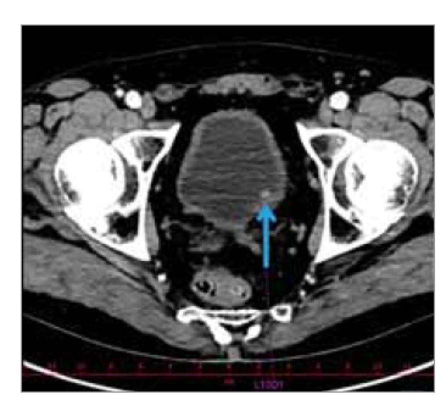 CT složka z fúzního PET/CT
zobrazující tumor močového měchýře
(označen modrou šipkou).<br>
Fig. 1. CT component from fusion
PET/CT showing bladder tumor
(marked with a blue arrow).