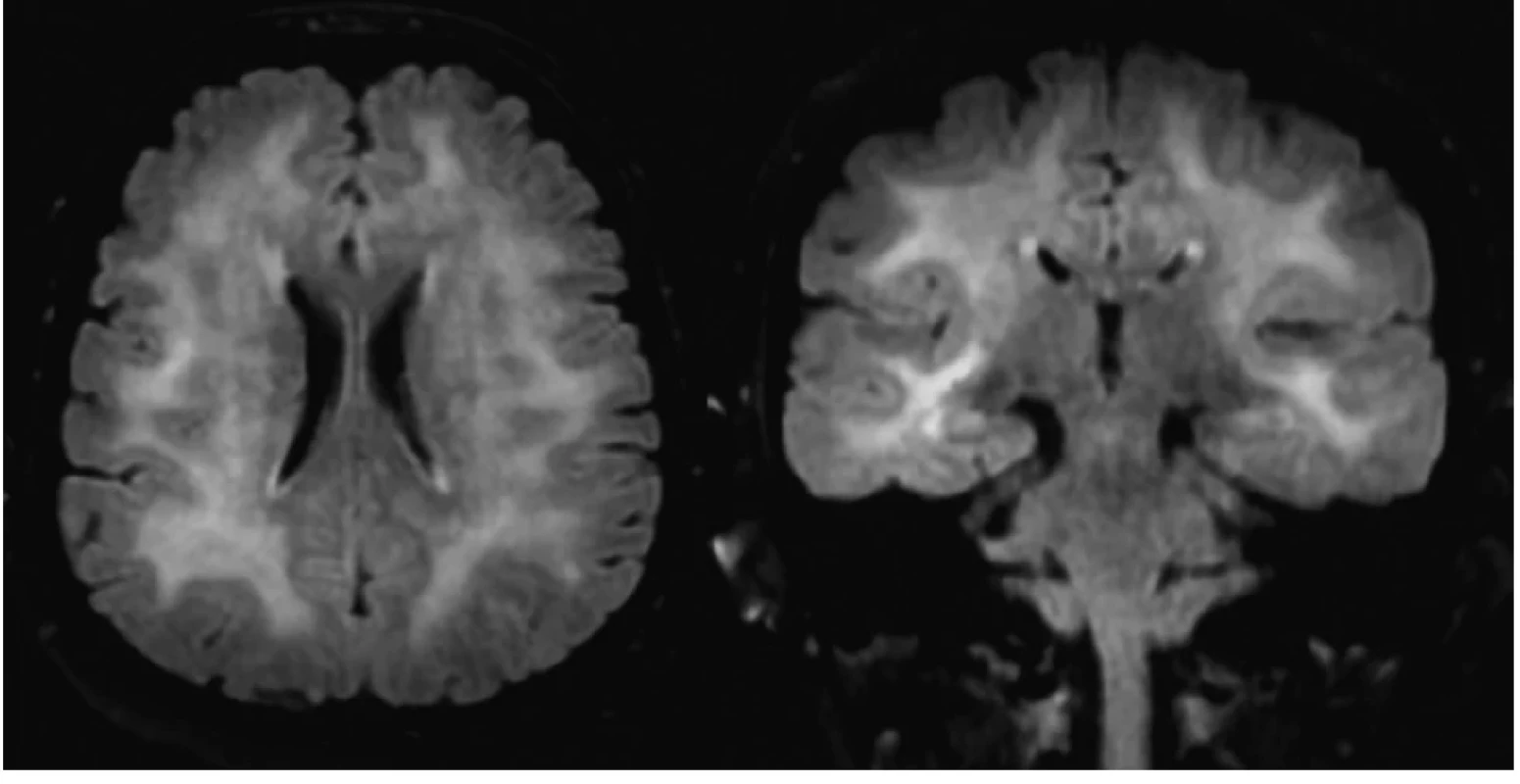 MRI nález difúznej leukoencefalopatie u pacientky so SREAT (vľavo axiálny rez, vpravo koronáry rez, FLAIR sekvencia)