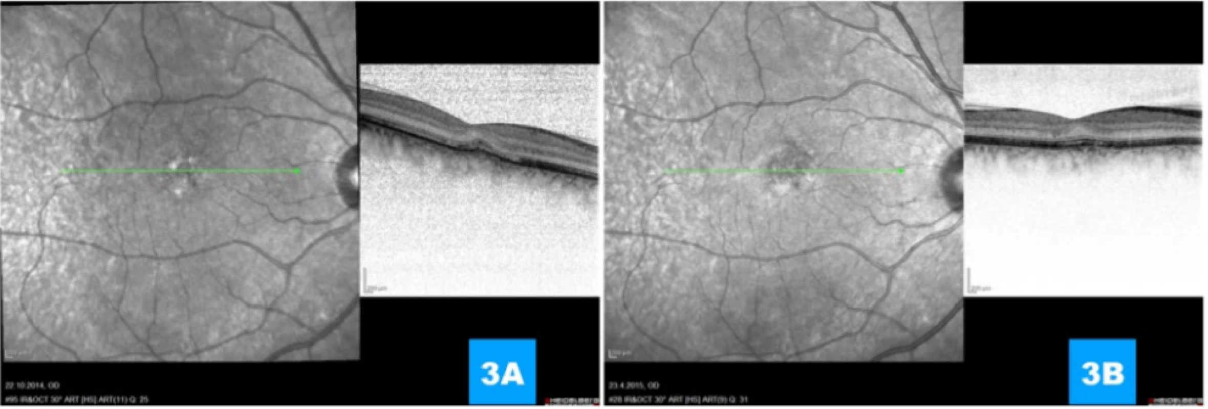  (A, B) Progressive absolute regression of classic portion, regression of subretinal fluid, preservation of membrana limitans
externa, renewal of interdigitation zone and intimation of extirpation of line of retinal pigment epithelium 1 month and 1 year
respectively after application of anti-VEGF agent 