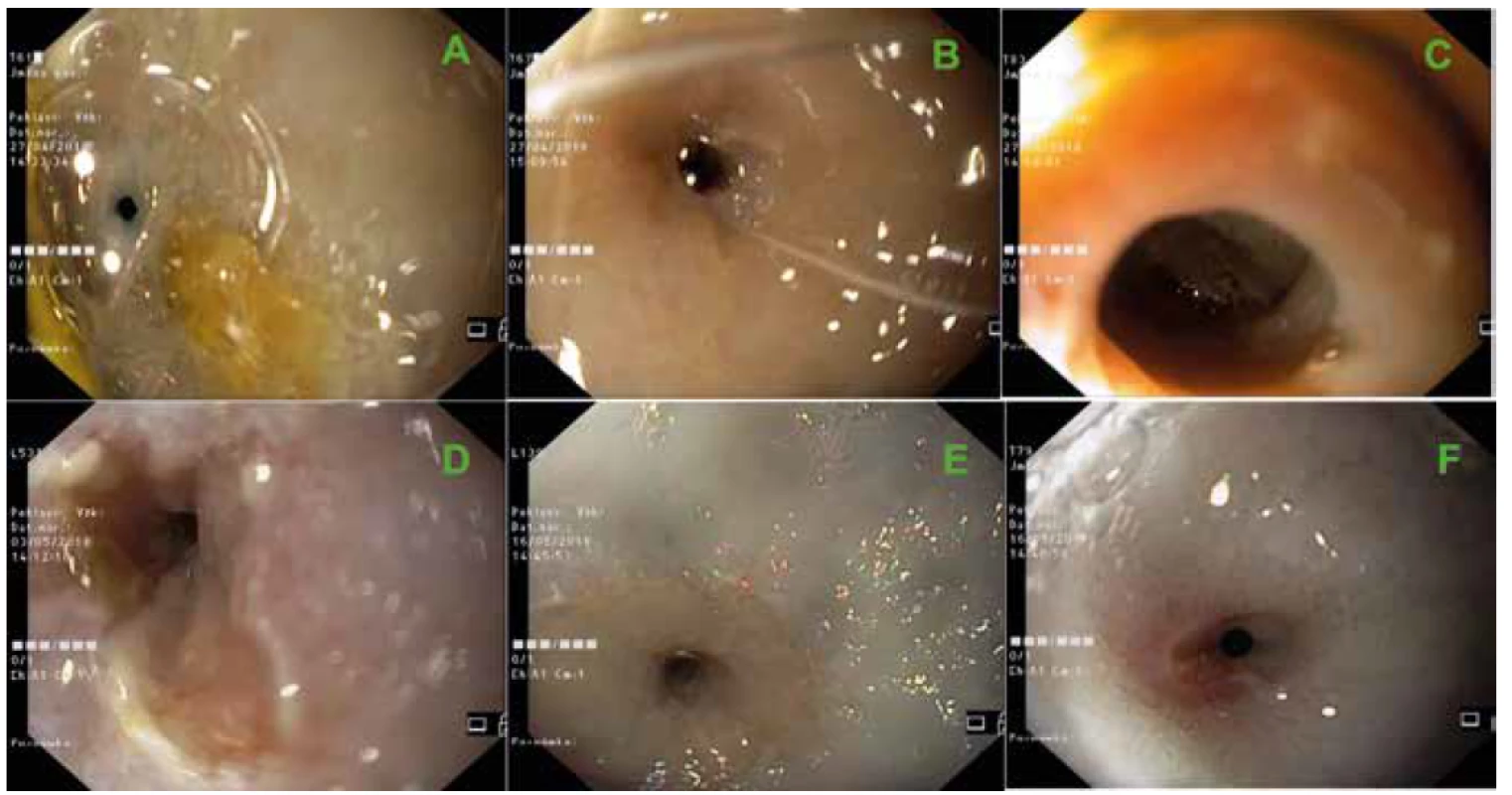 Endoscopic views of stricture sites developed after complete CED during control endoscopies just before necropsy.<br>
Minipigs T61 (A), T67 (B), T83 (C), L531 (D), L139 (E) and T79 (F).