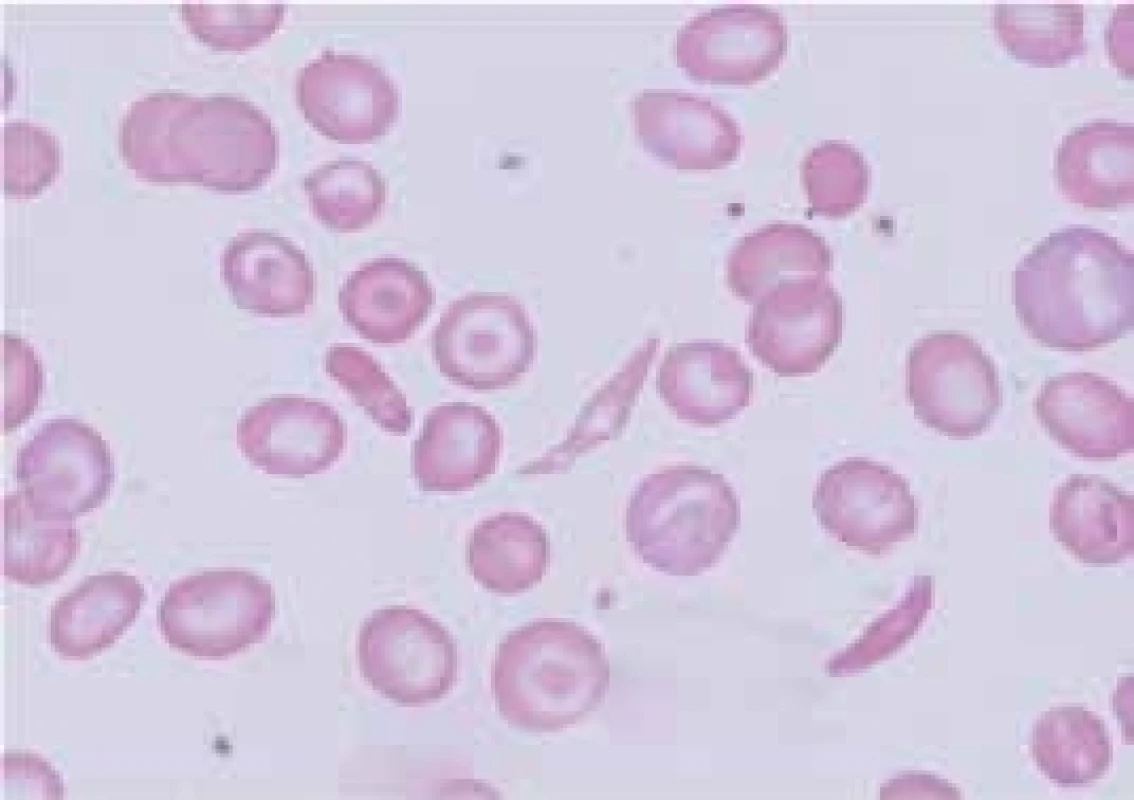 Nátěr periferní krve nemocného se srpkovitou
anémií – nápadné srpkovité krvinky, terčovité
buňky, sférocyt, anizocytóza