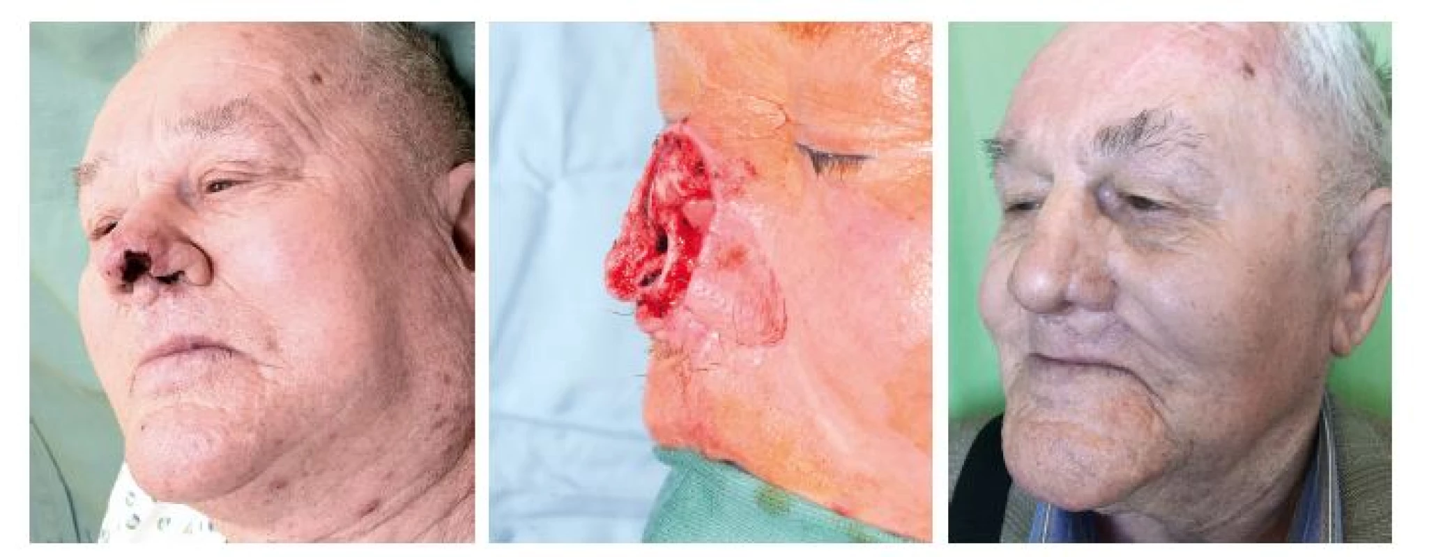Případ 2 – rozsáhlý kožní nádor špičky a levého nosního křídla: A) stav před operací, B) stav po radikální resekci tumoru, C) stav
po dokončení rekonstrukce nosu.