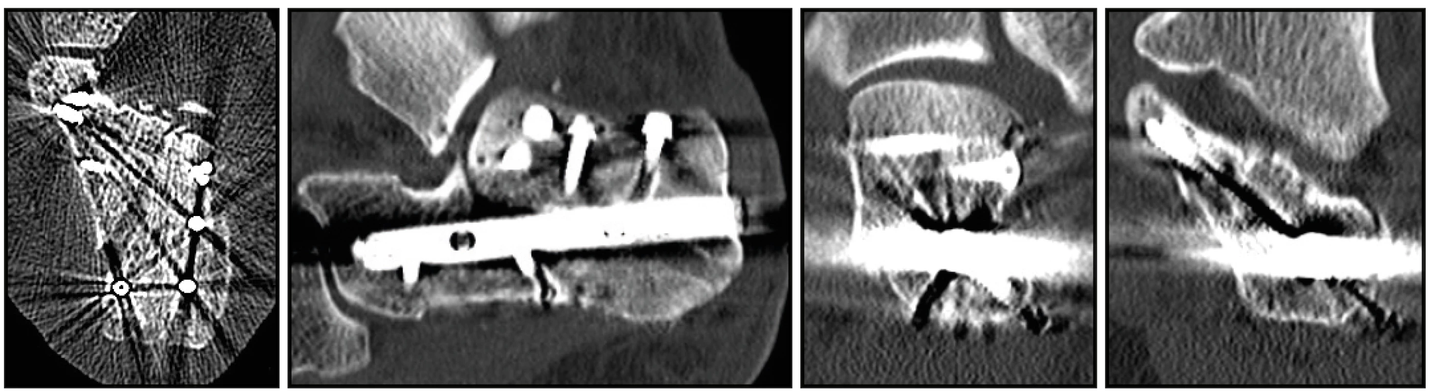 Pooperační CT obrazy po osteosyntéze zlomeniny patní kosti hřebem C-nail