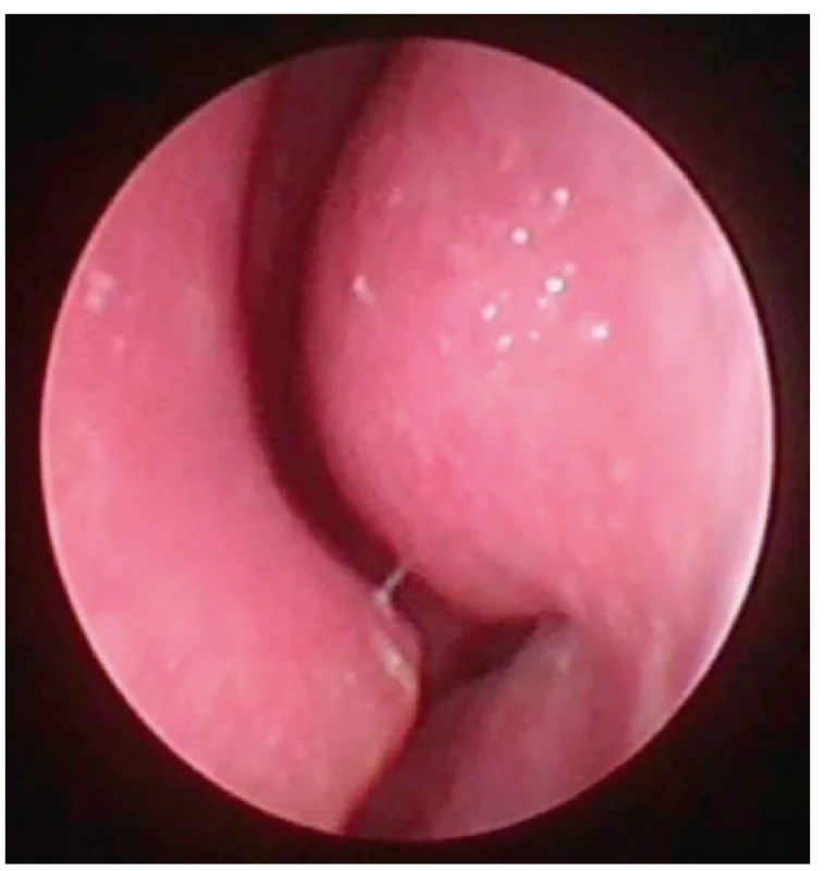 Pohled do nosní dutiny vlevo, endoskopická skupina<br>
I – vpředu jen nevýznamná spina septa (tedy typ 1 dle Mladinovy
klasifikace), není zjevná hypertrofie skořepy.