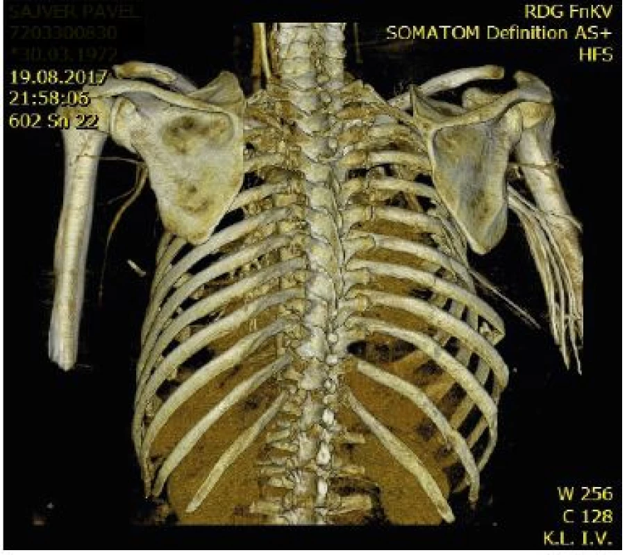 MDCT image of flail chest fracture of 7 ribs on the right, with
a deformity of the chest wall