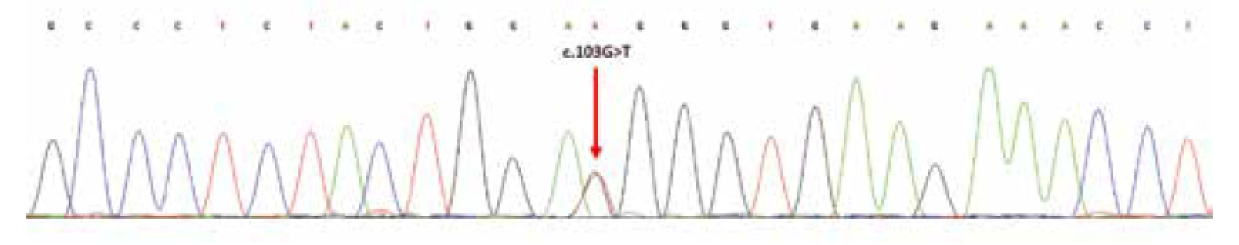 Sekvenční analýza exonu 2 genu
H3F3A; šipka označuje heterozygotní substituční
mutaci v pozici c.103G>T; resp.
náhradu aminokyselin glycin za tryptofan
(p.Gly35Trp; dle původního označení G34W).