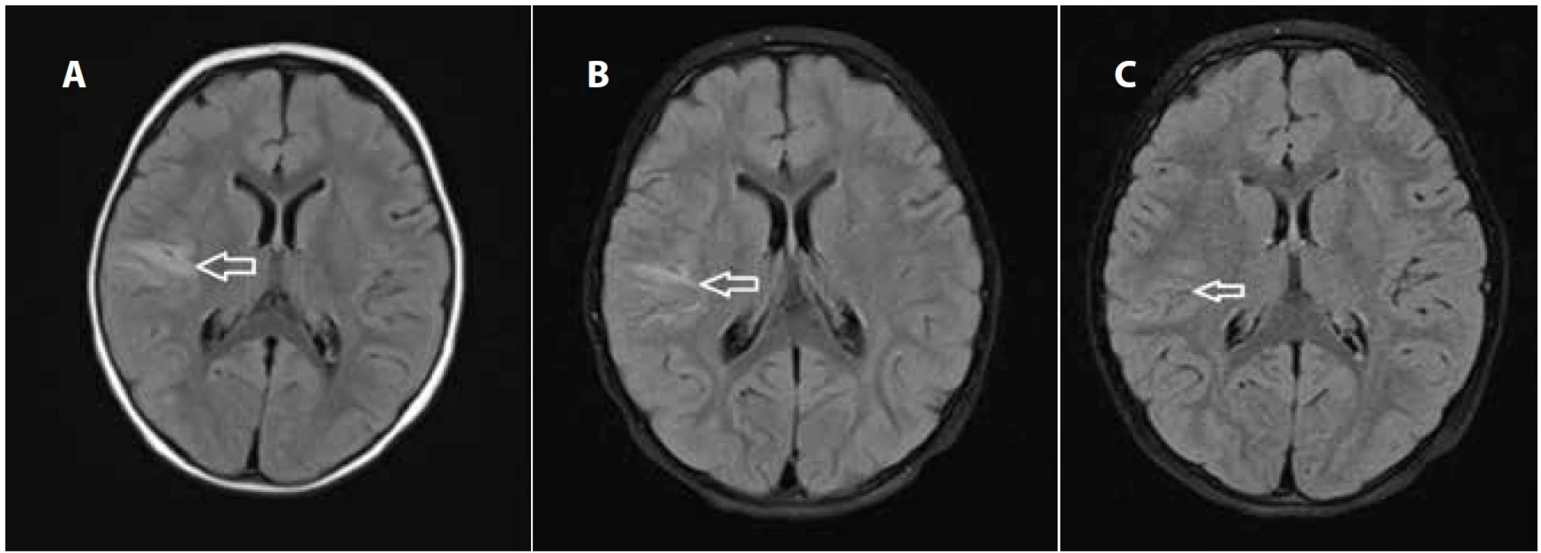Magnetická rezonance, T2 Flair skeny: a) vstupní – axiálně s T2 hypersignálním lemem juxtakortikálně až kortikálně na rozhraní
gyrus frontalis inferior a gyrus temporalis superior vpravo; b) za 2 týdny s přetrváváním edému; c) za 4 měsíce s diskrétními
reziduálními gliotickými změnami v místě původní ischémie.
Fig. 2. Magnetic resonance imaging, T2 Flair axial scan: a) initially T2 hypersignal area juxtacortically to cortically at the interface of
the inferior frontal gyrus and the superior temporal gyrus on the right side b) after two weeks with the persistence of oedema and
gliosis; c) after four months with discrete residual gliotic changes at the site of the original ischemia.