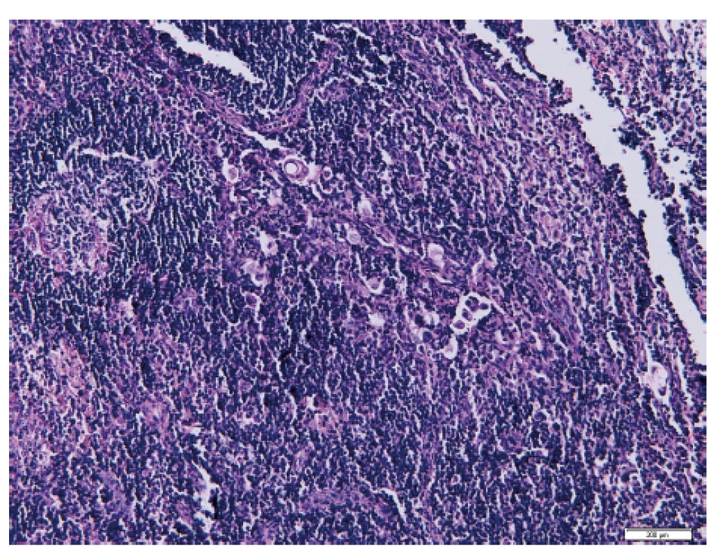 Izolované nádorové buňky v sentinelové lymfatické uzlině
po barvení hematoxylinem-eozinem (Ústav klinické a molekulární
patologie LF UP a FN Olomouc)