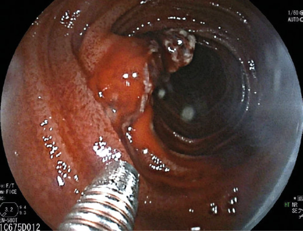 Dieulafoy lézia jejúna – dvojbalónová endoskopia 