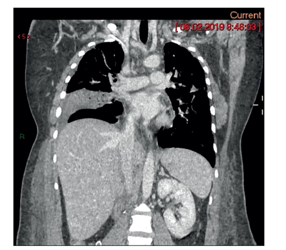 Pooperačný stav – pľúcnica a dolná dutá žila bez
embolu<br>
Fig. 5: Postoperative condition – pulmonary artery and
inferior vena cava without the embolus
