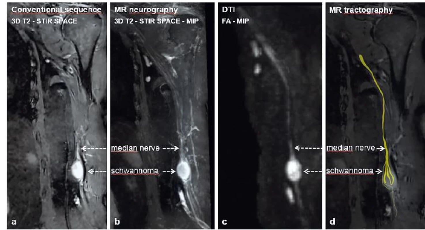 Median nerve schwannoma showed using (a) conventional MRI sequence – 3D T2–STIR SPACE, (b) MRN–3D T2–STIR SPACE–MIP
reconstruction, (c) DTI–FA–MIP reconstruction and (d) MRT
DTI= diffusion tensor imaging; FA= fraction anisotropy; MIP= maximum intensity projection; MRN= MR neurography; MRT= MR
tractography; SPACE= sampling perfection with application optimized contrast using varying flip angle evaluation; STIR= short tau
inversion recovery; T2= T2 weighted images