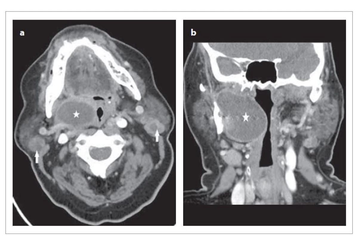 CT snímky v axiální rovině (a) a koronární rovině (b). Šipky ukazují
tumory příušní žlázy, hvězdička cystický útvar parafaryngeálního prostoru
vpravo (41 x 31 x 56 mm).<br>
Fig. 1. CT images in the axial plane (a) and the coronary plane (b). Arrows indicate
parathyroid tumors, asterisk cystic formation of the parapharyngeal space on the
right (41 x 31 x 56 mm).