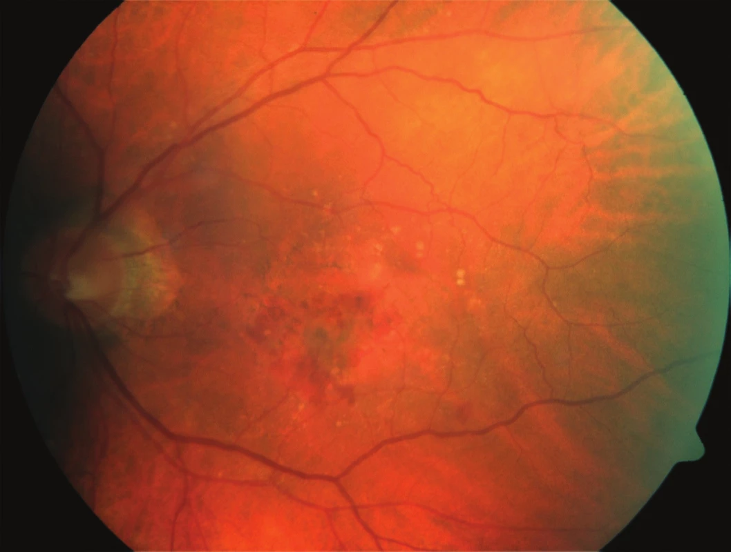 Initial fundus photography: patient
– 75-year-old male, initial BCVA 63 ETDRS
letters, CRT 348 μm, fluorescence angiography
– minimally classic CNV.