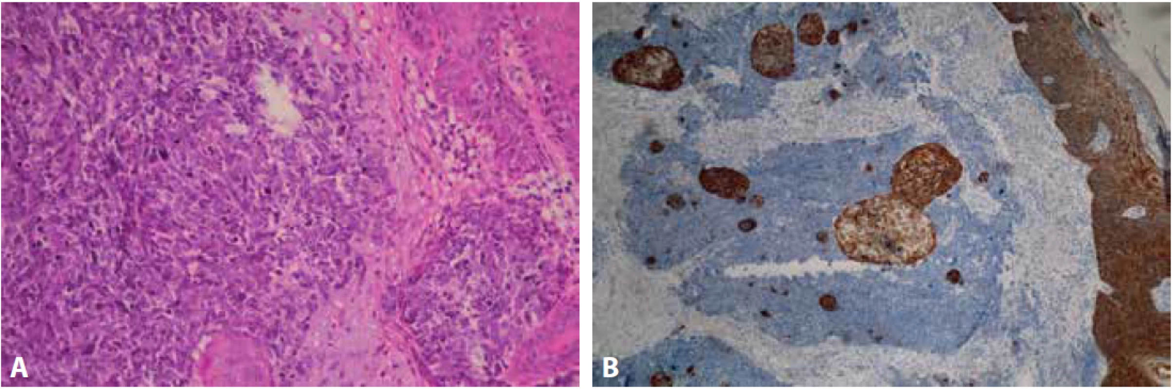 Mikroskopický obraz primárního tumoru s četnějšími skvamózními partiemi (A – barvení hematoxylin eozin, zvětšení 100x). Silná cytoplazmatická exprese AE1/AE3 v epidermis a skvamózních partiích (B – zvětšení 100x).