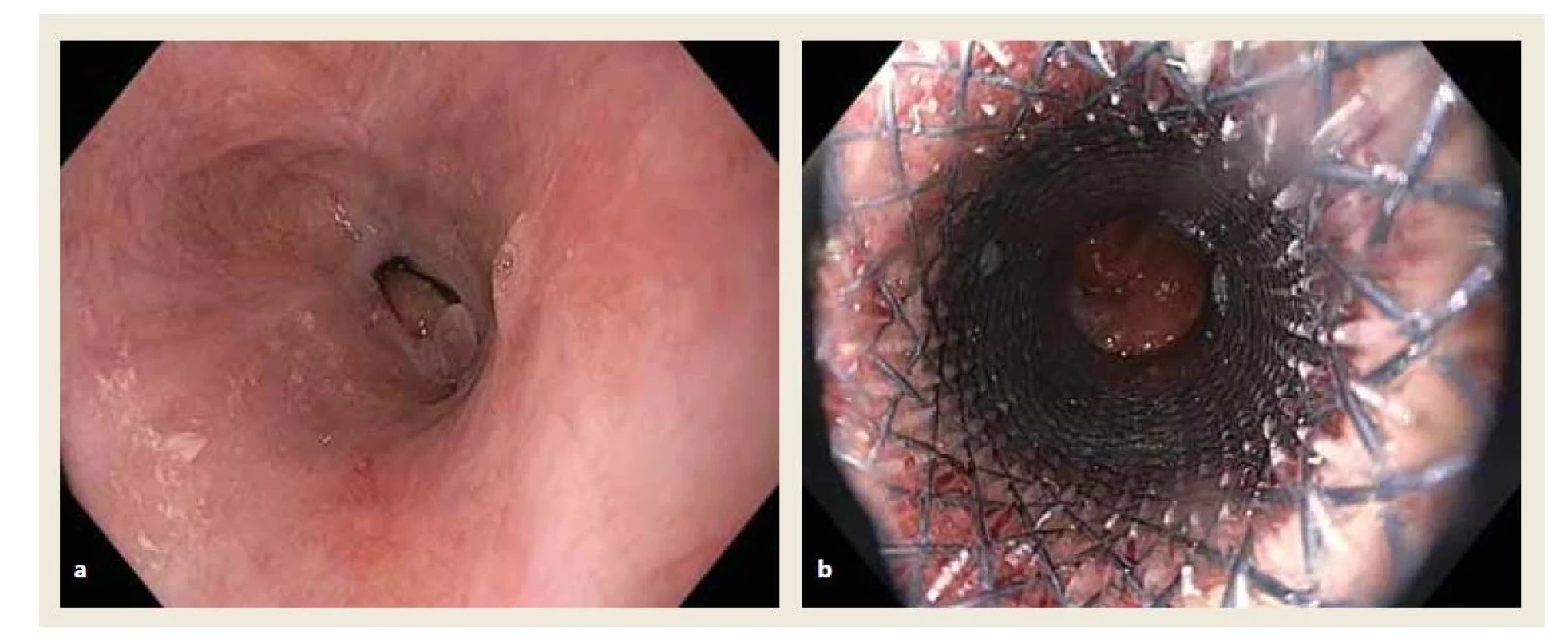 a) Endoskopický obraz těsné fibrotické stenózy distálního jícnu.<br>
Obr. 3b) Endoskopický pohled do plně potaženého nitinolového jícnového stentu zavedeného do distálního jícnu přes
kardii do žaludku.<br>
Fig. 3a) Endoscopic image of a tight fibrotic stenosis of the distal esophagus.<br>
Fig. 3b) Endoscopic view of a fully coated nitinol esophageal stent inserted into the distal esophagus through the cardia into
the stomach.
