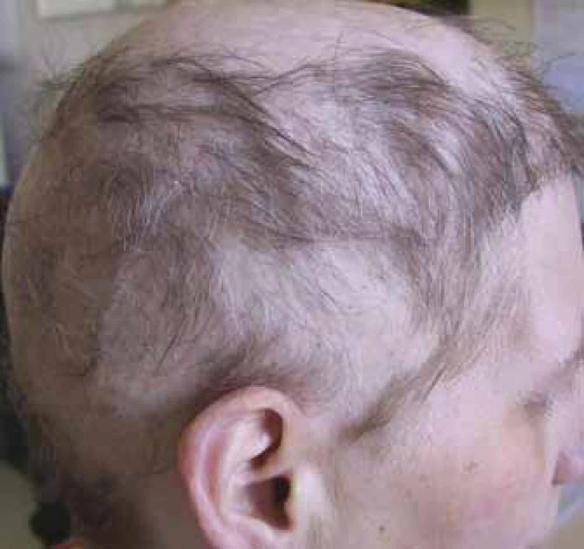 Alopecie jizvící, pokročilé stadium
(foto H. Jedličková).
