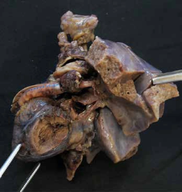 Syndrom hypoplatického levého srdce. Pohled zleva na hypoplastickou
levou komoru. Srdce je po částečné chirurgické korekci (proběhla 1. fáze
Norwoodovy procedury), na levé straně snímku je patrný goretexový Sano
shunt tvořící komunikaci mezi dominantní pravou komorou a plicní arterii.
