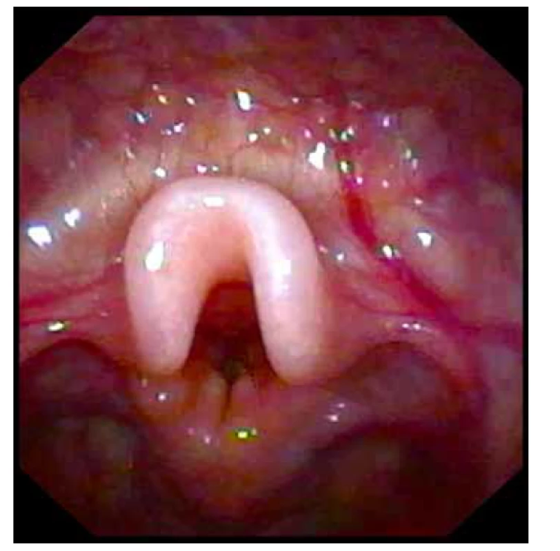 Omegovitý, kornoutovitý, napřímený tvar epiglotis u 4měsíčního dítěte