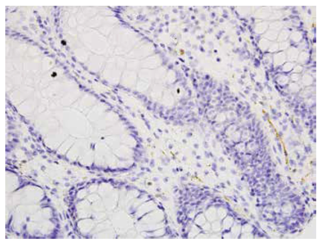 Ojedinělá kalretinin pozitivní vlákna v lamina propria mucosae, negat-
HN, 2 cm od anu (400x).