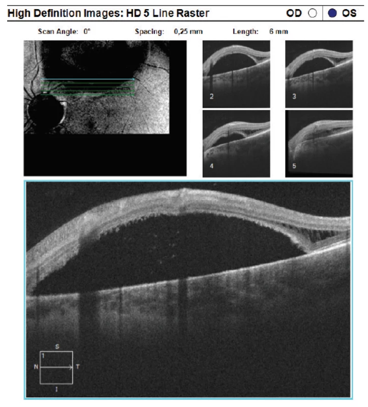 HD-OCT: Lineární horizontální transretinální
sken levého oka vedený v superotemporální peripapilární
oblasti s patrnou rozsáhlou oblastí vysoké serózní ablace
neuroretiny s akumulací tekutiny subretinálně, v temporálních
oblastech opět patrná schíza retinálních vrstev
sítnic