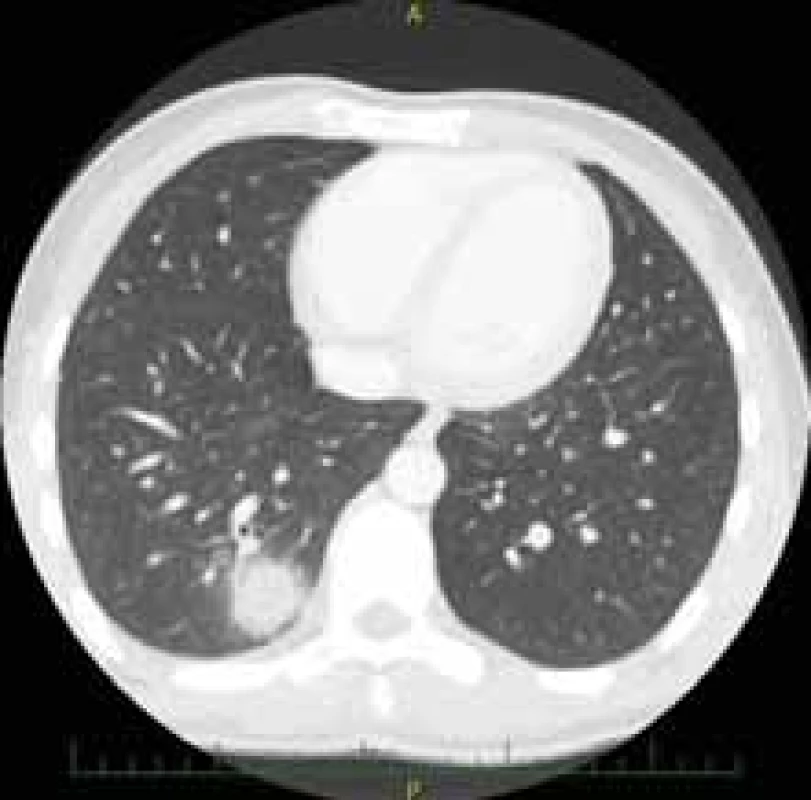 Solitární ložisko plic.<br>
Fig. 3. Solitary lung focus.