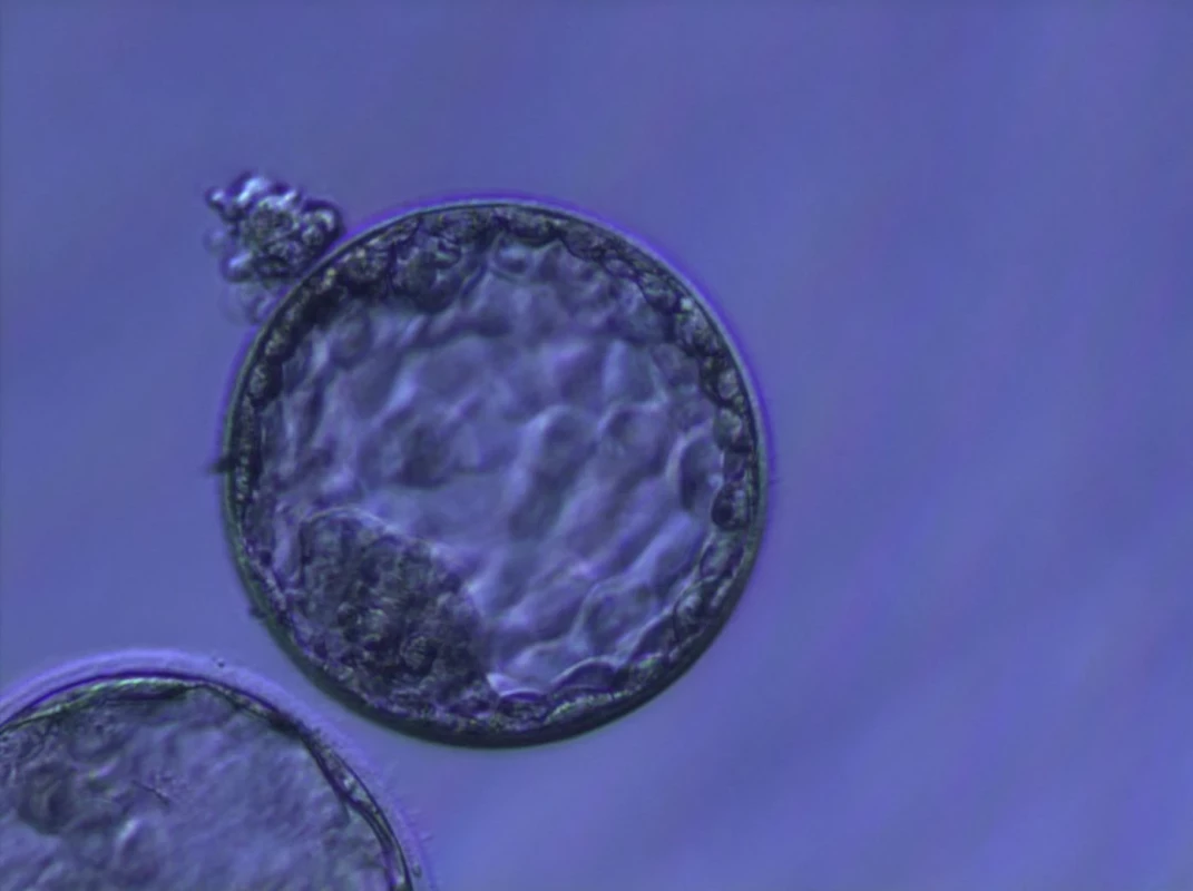 Blastocysta (5denní embryo)