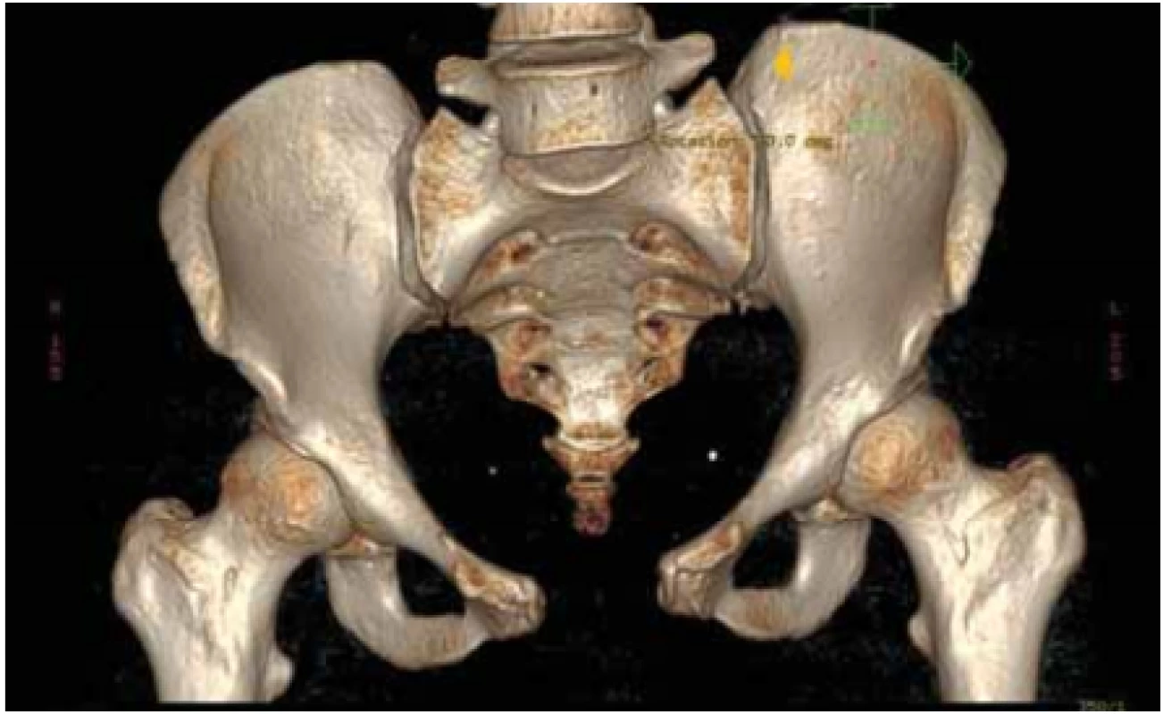CT 3D rekonštrukcia panvy s evidentnou symfyzeolýzou.<br>
Fig. 1. CT 3D reconstruction of the pelvis with evident symphyseolysis.