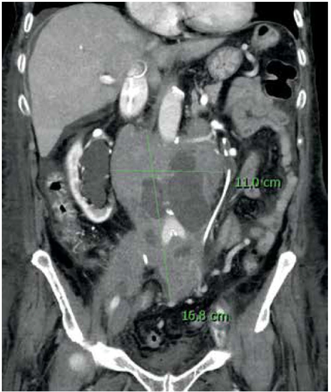 B-lymfom retroperitonea, hydronefróza pravé ledviny<br>
Fig. 4. B-lymphoma in the retroperitoneum, hydronephrosis
of the right kidney