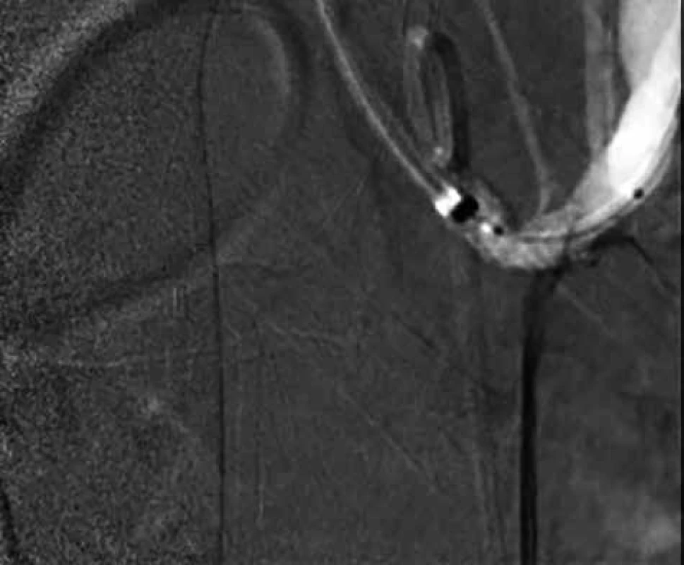 PTA stenózy kmene TC se zavedením stentu – 
snímky digitální subtrakční angiografie<br>
Fig. 4: PTA of the TC stenosis with the placed stent – images 
of digital subtraction angiography