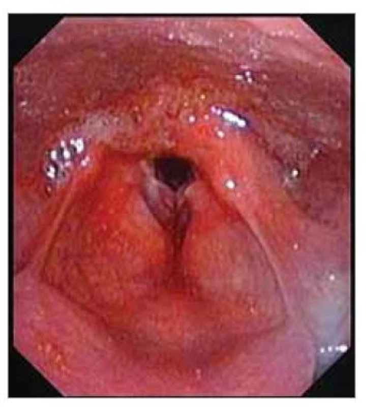 Flexibilní laryngoskopie při
přijetí. Hyperemie sliznic, sliny s příměsí
krve v hrtanovém vchodu a piriformních
recesech, otoky a hematomy
hlasivek.<br>
Fig. 2. Flexible laryngoscopy on admission.
Mucosal hyperemia, saliva with
blood in the laryngeal entrance and
piriform sinuses, swelling and hematoma
of the vocal cords.