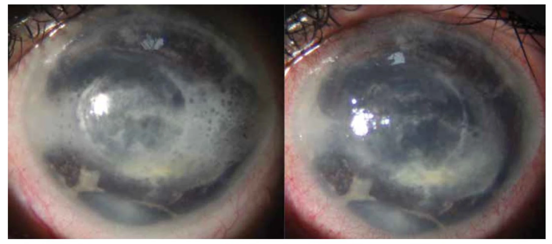 Vlevo předoperační nález pacientky č. 3, vpravo pooperační stav stejného oka