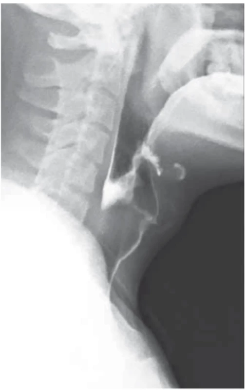 RTG snímek zaklíněného sousta v oblasti jugula se známkami aspirace kontrastní látky.<br>
Fig. 1. X-ray picture of food stuck in
jugular area with signs of contrast
aspiration.