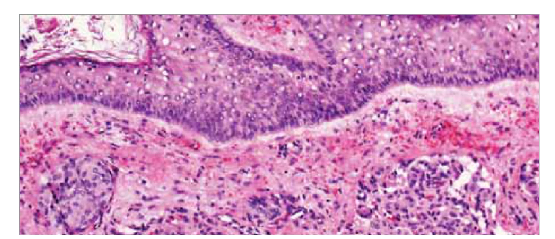 Histologické vyšetření meningeomu I. stupně podle WHO, barvení hematoxylin-
eozin. Je přítomný fragment tkáně kryté rohovějícím dlaždicobuněnčným
epitelem, pod kterým jsou v překrveném, lehce edematózním vazivovém
stromatu zastiženy nádorové struktury tvořené hnízdy buněk vzhledu
buněk meningoteliomatózních, s poměrně bohatou eozinofilní cytoplazmou,
oválnými jádry s mírnou anizokaryózou, jemným chromatinem, bez mitóz
a bez výraznějších atypií.<br>
Fig. 3. Histological examination of WHO grade I meningoma, hematoxylin-eosin
staining. A fragment of tissue covered by horned squamous cell epithelium is presented,
under which tumor structures formed by nests of meningotheliomatous
cell-like cells with relatively rich eosinophilic cytoplasm, oval nuclei with mild anisocaryosis
and mild chromosome, and mild chromium.