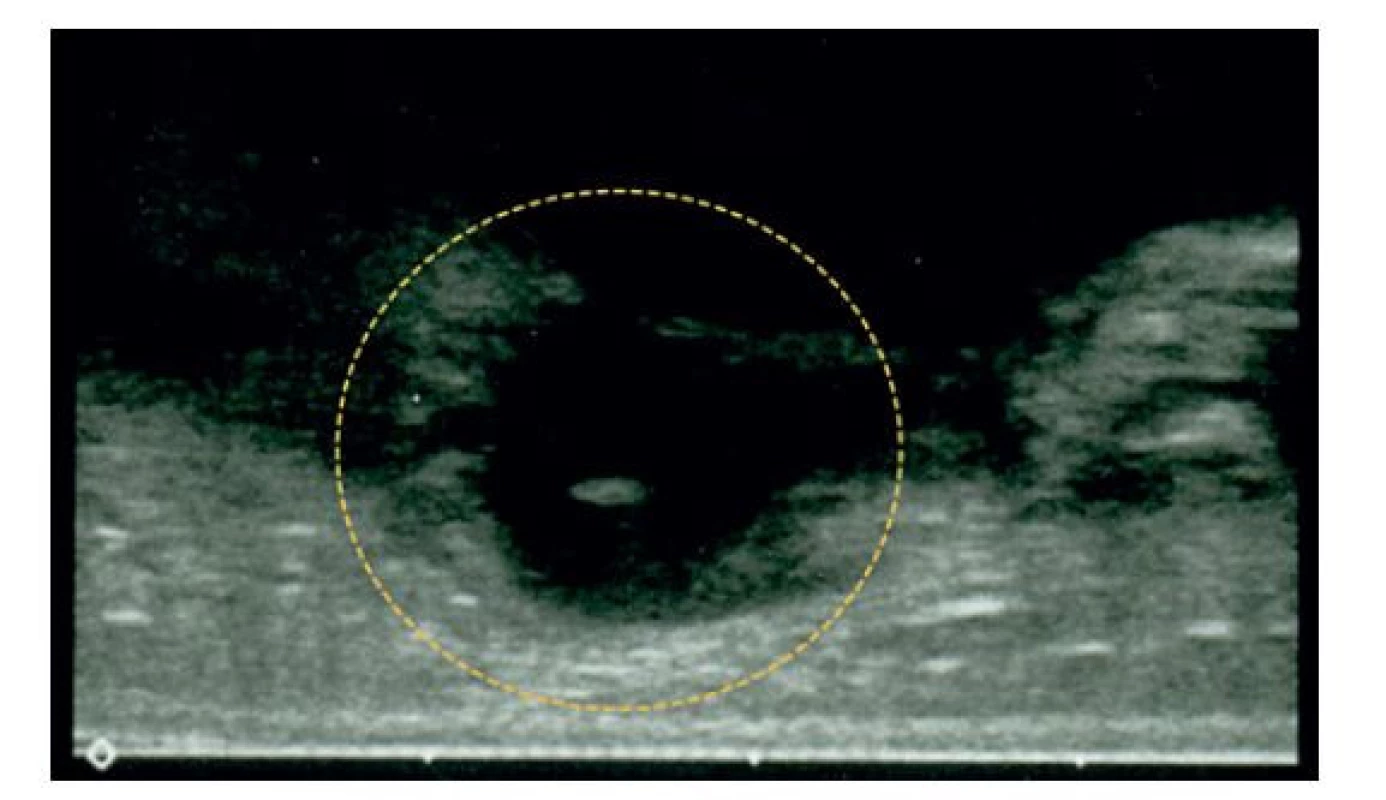 Distrahovaný mediální epikondyl zachycený na ultrazvukovém
vyšetření<br>
Fragment není inkarcerován v kloubu.<br>
Fig. 3: Ultrasound image of the displaced medial epicondyle<br>
The fragment is not interposed in the elbow joint.