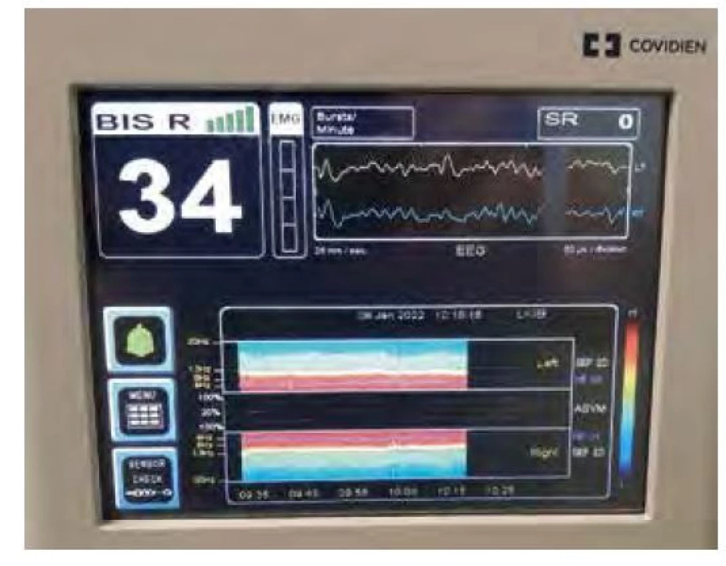 Displej monitoru BIS zobrazuje index hloubky anestezie BIS měřený
z pravé strany čela, nulovou aktivitu na EMG, dva svody EEG. Bursty nebyly
zjištěny, proto je SR (Suppression Ratio) 0. V dolní části je zobrazena spektrální
analýza EEG (viz další článek)