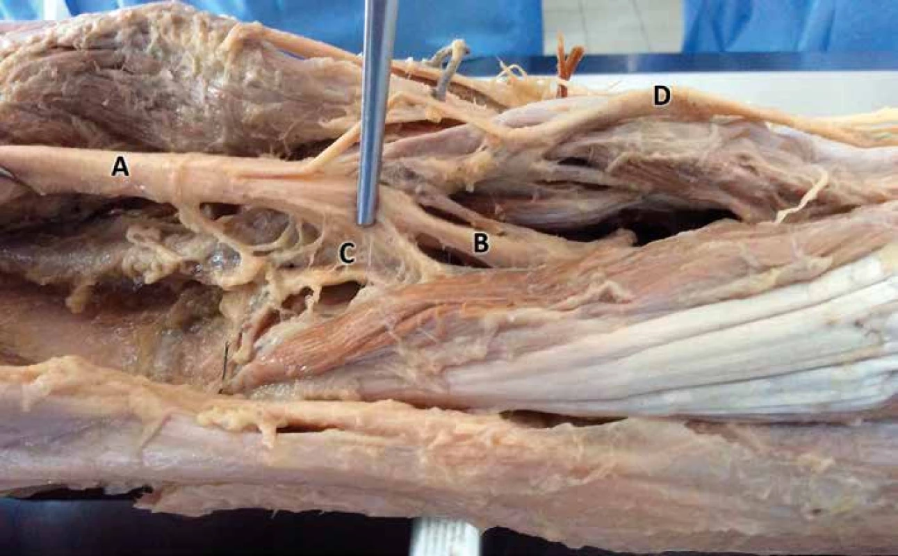 N. ischiadicus anatomický preparát. A. nervus ischiadicus, B. nervus tibialis, C. nervově cévní zásobování popliteální části kolena, D. nervus peroneus
