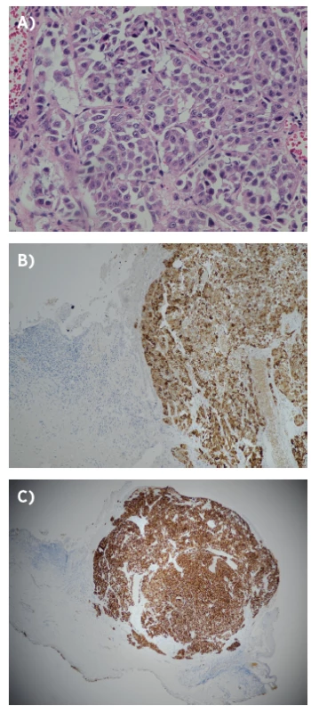 Neuroendokrinný karcinóm - histopatologický obraz,
kazuistika 1.<br>
A – heatoxylín-eozín, B – chromogranín, C – synaptofyzín