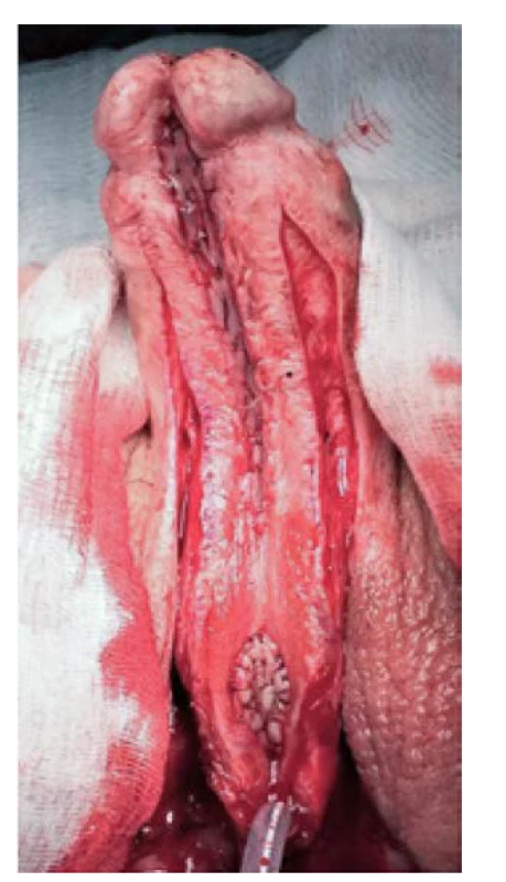 Aplikace bukálního štěpu dorzálně
inlay dle ASOPY<br>
Fig. 5. Dorsal inlay bucal mucosal
graftig according to ASOPA