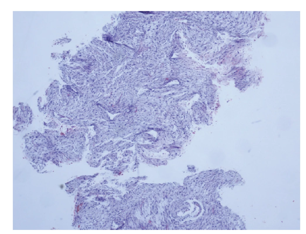 Core cut biopsie, fragment pocházející z fibroadenomu,
nelze vyloučit přítomnost fyloidního nádoru.<br>
Fig. 4: Core cut biopsy, fragment of fibroadenoma, the
presence of a phyllodes tumor cannot be excluded.