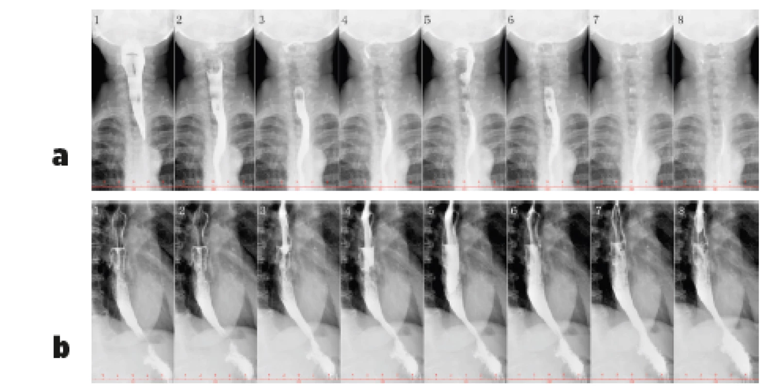 Vyšetření polykacího aktu pomocí RTG jícnu
s kontrastem – bariová suspenze (200 ml Micropaque) u pacientky
s dysmotilitou jícnu při SSc (z archivu Revmatologického ústavu)
Je patrný volně výbavný polykací akt. Horní část jícnu (obr. 3a)
není rozšířená a pasáž je volná, na snímku 1 a 2 je dobře patrná
projekce osteofytů krční páteře do zadní stěny hypofaryngu.
Pod obloukem aorty (obr. 3b) se jícen hypotonicky rozšiřuje
a peristaltika je vymizelá, jícen se konicky zužuje k hiátu –
kontrastní látka zde stagnuje a žaludek se poté plní užším kanálem.<br>
3a Předozadní projekce, horní část jícnu<br>
3b Boční projekce, dolní část jícnu (včetně části pod
aortálním obloukem)